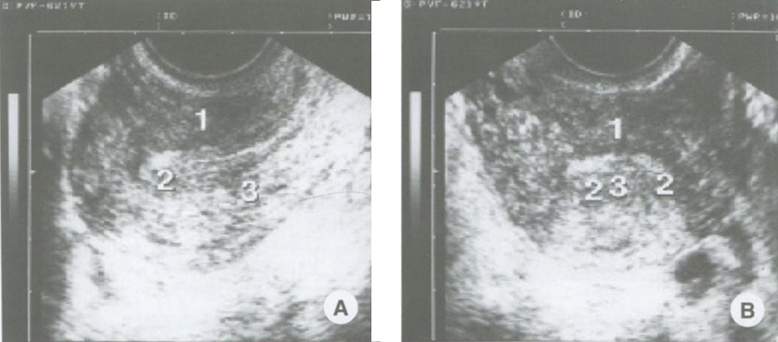 Очаговая гиперплазия эндометрия