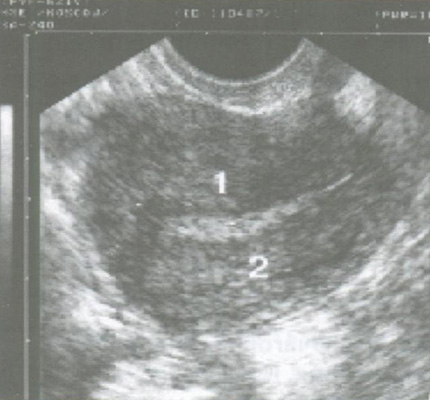 Железисто-кистозная гиперплазия эндометрия