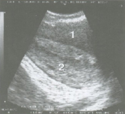  Железисто-кистозная гиперплазия эндометрия