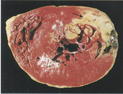  Острый инфаркт миокарда заднебоковой стенки левого желудочка