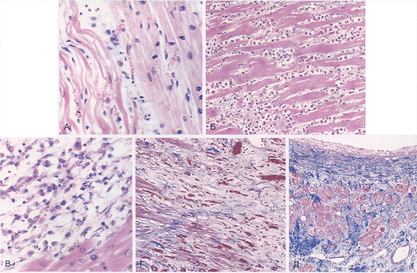 Гистологические признаки инфаркта миокарда и его заживления