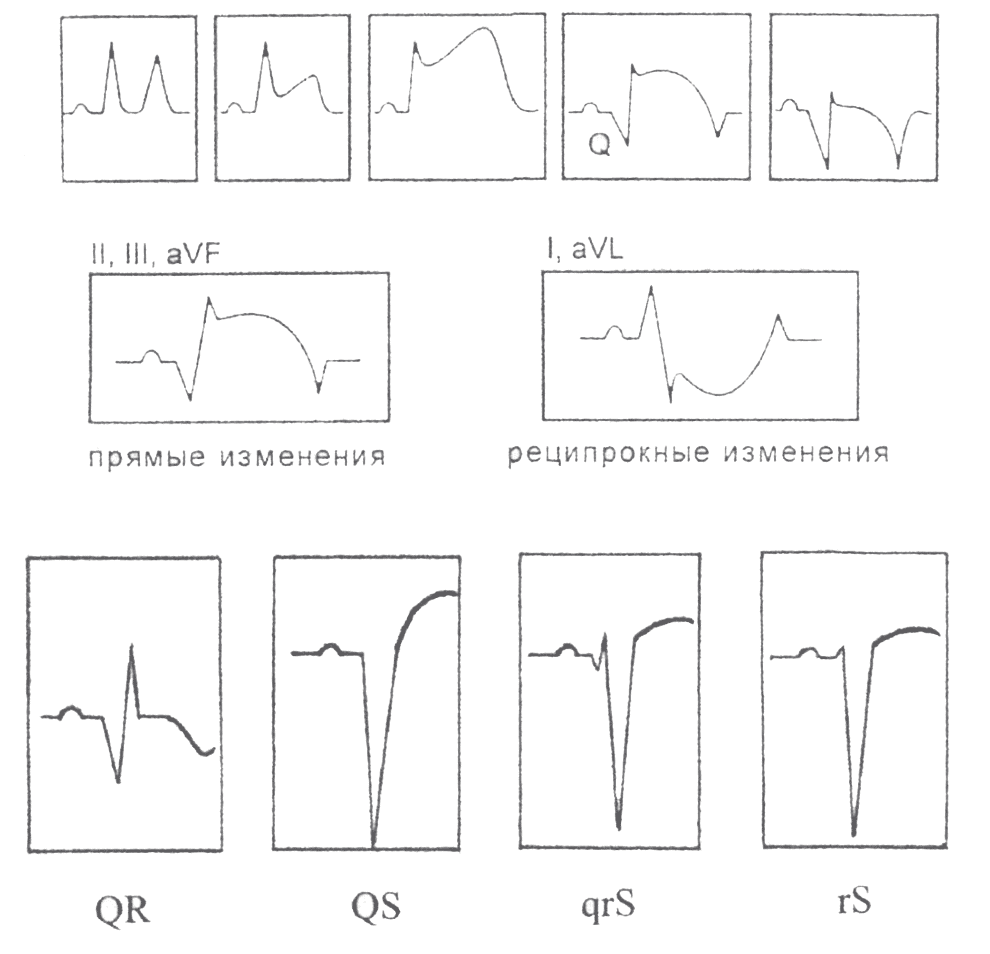 Рис. 11. Типичные изменения ЭКГ при инфаркте миокарда с зубцом Q.