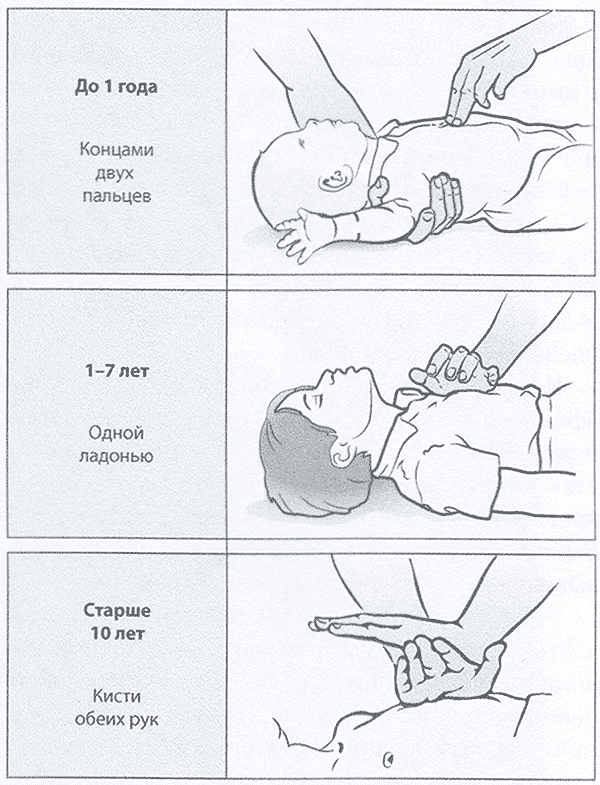  Непрямой массаж сердца у детей