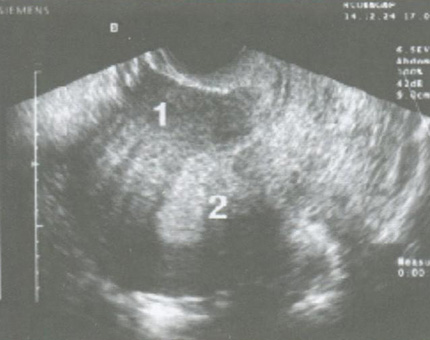 Железисто-кистозная гиперплазия эндометрия