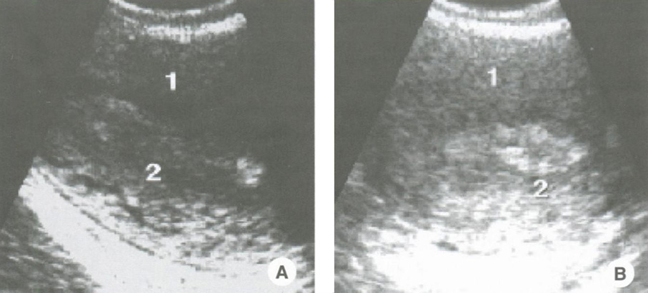  Железисто-кистозная гиперплазия эндометрия