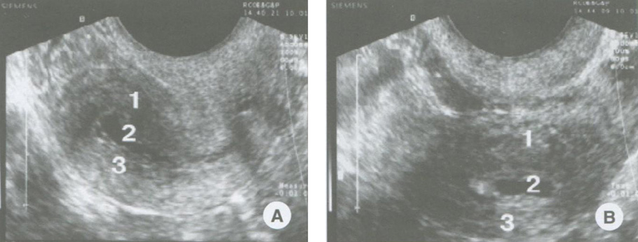Серозометра. Железисто-кистозная гиперплазия эндометрия