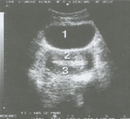 Атипическая гиперплазия эндометрия