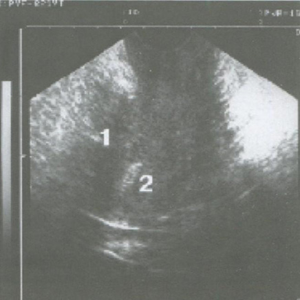Атипическая гиперплазия эндометрия
