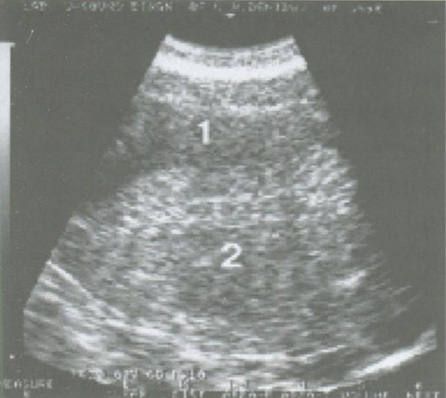 Атипическая гиперплазия эндометрия