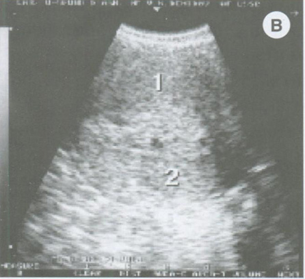 В. поперечное ТВ-сканирование
