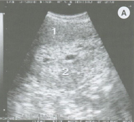 Атипическая гиперплазия эндометрия