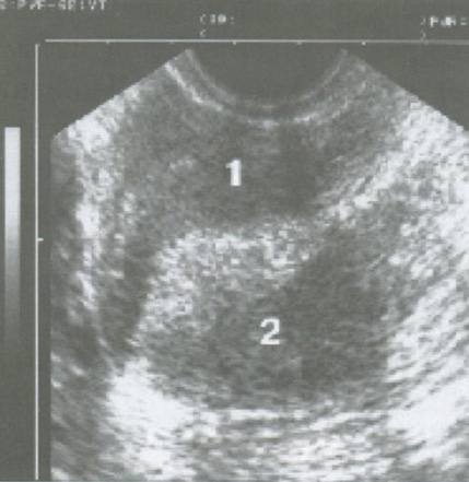 Атипическая гиперплазия эндометрия