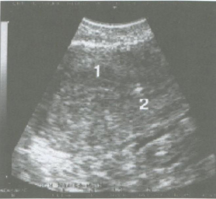 Склерозированный полип