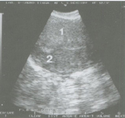  Железисто-кистозный полип эндометрия