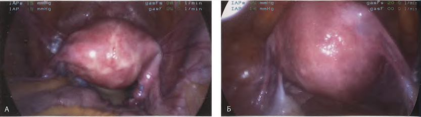 Лапароскопический вид матки на месте (in situ). Б. Увеличенное изображение матки и образований широких связок Лапароскопический вид матки на месте (in situ). Б. Увеличенное изображение матки и образований широких связок