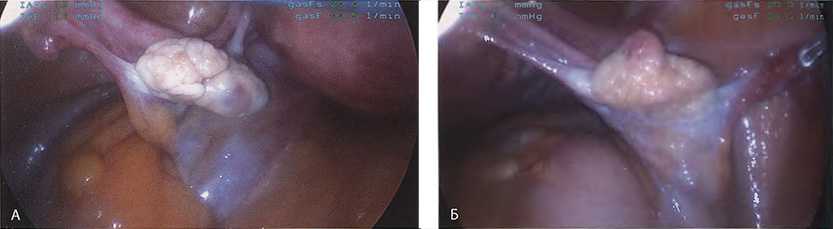 Увеличенное изображение левого придатка Увеличенное изображение левого придатка