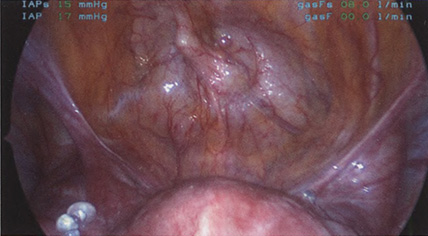 Панорамный вид мочевого пузыря, правых и левых круглых и широких связок Панорамный вид мочевого пузыря, правых и левых круглых и широких связок