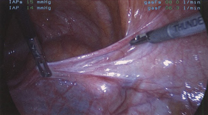 Левая круглая связка натянута, подготовлена к коагуляции и рассечению Левая круглая связка натянута, подготовлена к коагуляции и рассечению