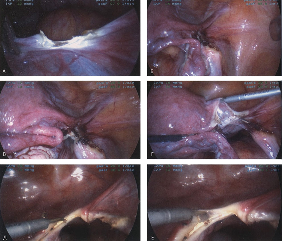 Круглая связка коагулирована и рассечена Круглая связка коагулирована и рассечена