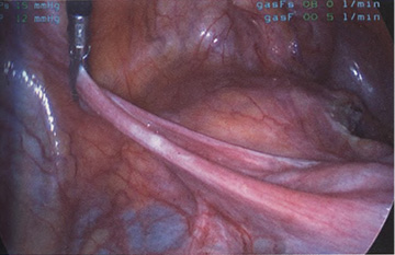 Натянуты правая круглая связка и правая широкая связка Натянуты правая круглая связка и правая широкая связка