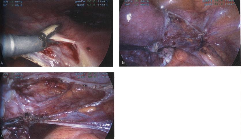 Брюшина мочевого пузыря коагулирована и частично рассечен Брюшина мочевого пузыря коагулирована и частично рассечен