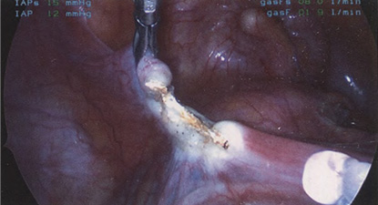 Круглая связка коагулирована и пересечена Круглая связка коагулирована и пересечена