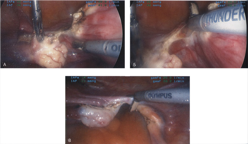 Пересечена собственная связка яичника Пересечена собственная связка яичника