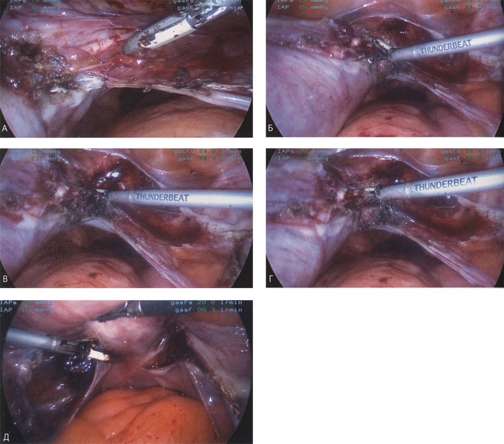 Маточные сосуды выделены на протяжении, коагулированы и пересечены Маточные сосуды выделены на протяжении, коагулированы и пересечены