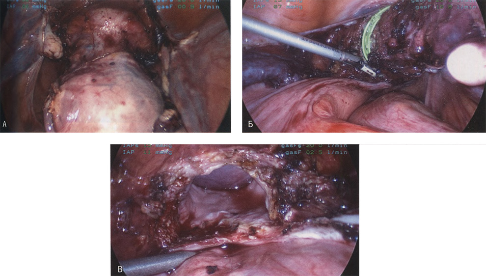 Матка полностью мобилизована и видна выпуклость на месте введённого во влагалище инструмента Матка полностью мобилизована и видна выпуклость на месте введённого во влагалище инструмента