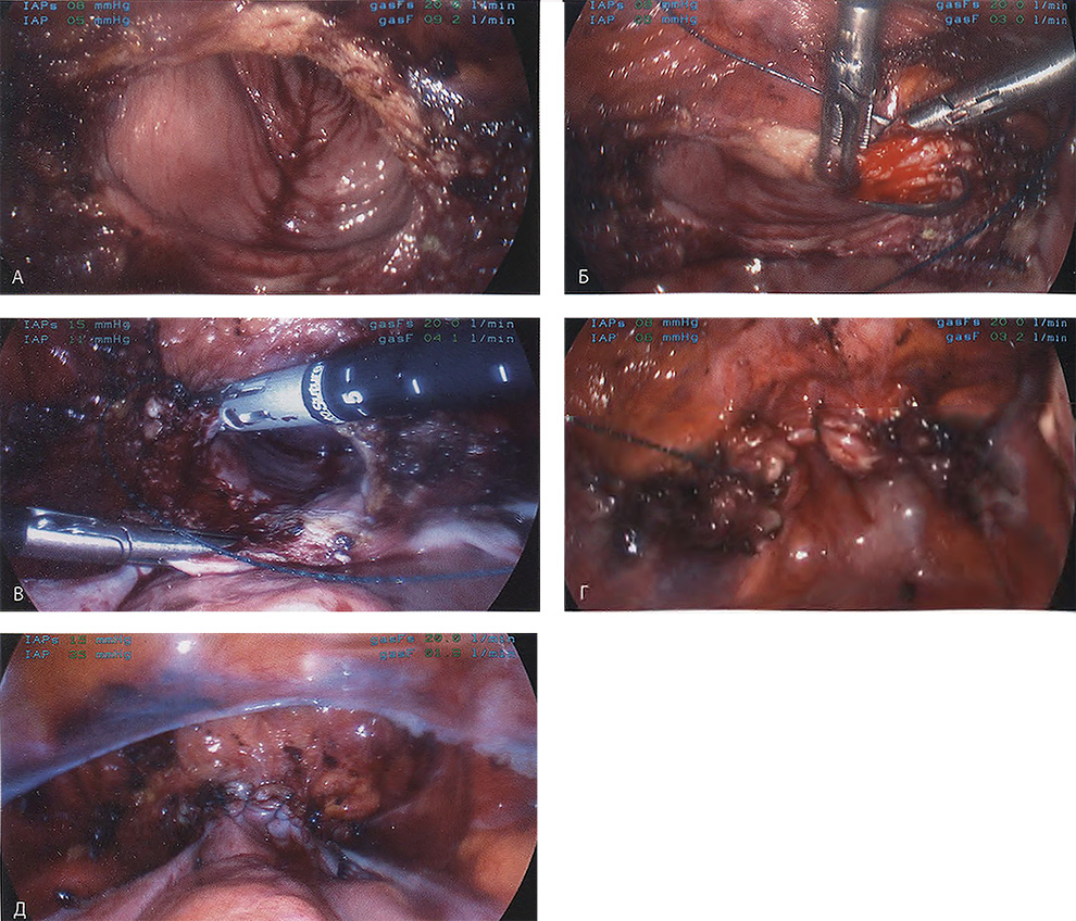 Видно вскрытое влагалище; обратите внимание на переднюю стенку влагалищной манжетки Видно вскрытое влагалище; обратите внимание на переднюю стенку влагалищной манжетки