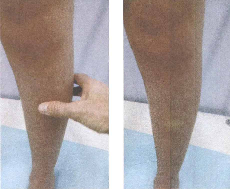 Изменение окраски (цианоз) кожных покровов голени при тромбозе глубоких вен Изменение окраски (цианоз) кожных покровов голени при тромбозе глубоких вен