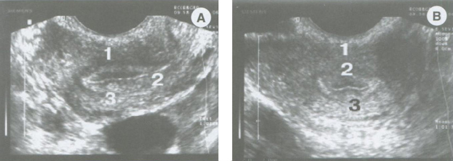 Железисто-кистозный полип эндометрия