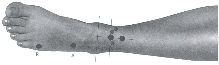 Схема расположения точки стимуляции на уровне лодыжек. Варианты положения стимулирующего электрода