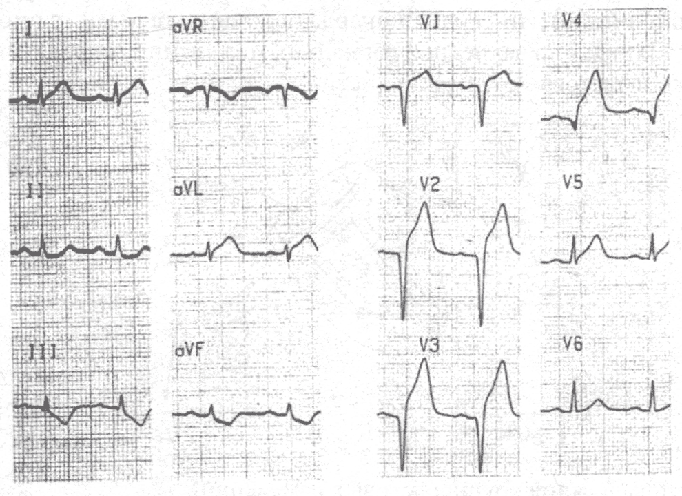 ЭКГ у больного с инфарктом миокарда с зубцом Q передне-перегородочной локализации.