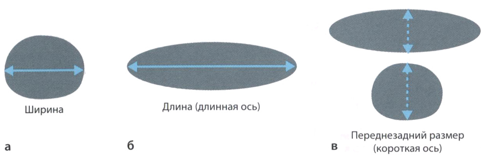  Схема измерения размеров лимфатического узла (пояснение в тексте)