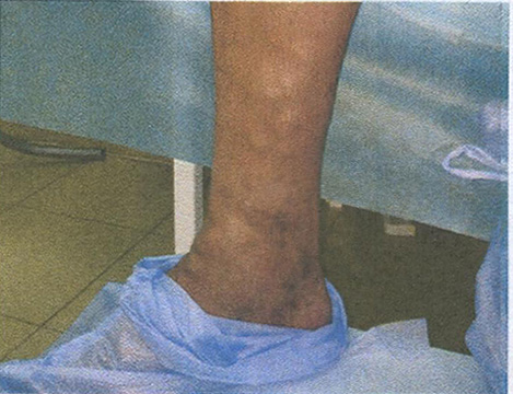 Флебэктатический венец — признак «запущенного» хронического заболевания вен нижних конечностей Флебэктатический венец — признак «запущенного» хронического заболевания вен нижних конечностей