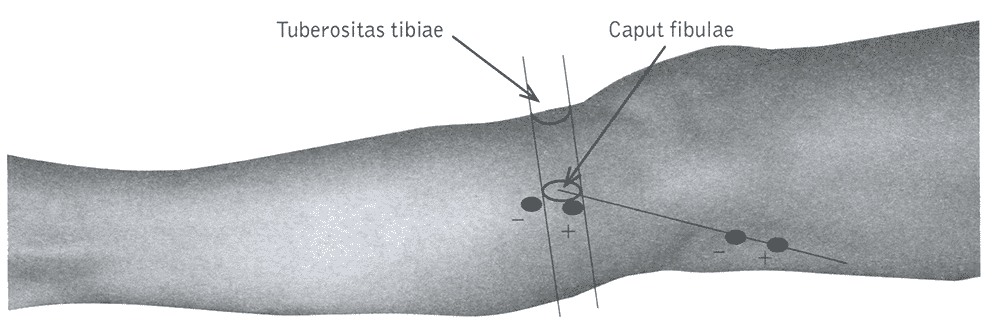 Схема расположения точек стимуляции при исследовании глубокого малоберцового нерва