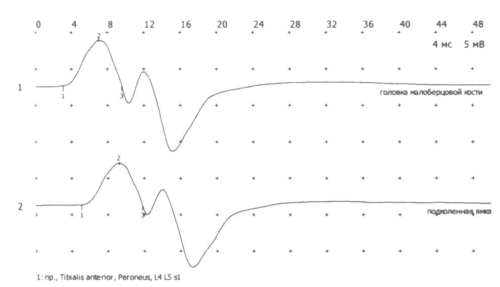 Пример ответов, полученных при исследовании глубокого малоберцового нерва