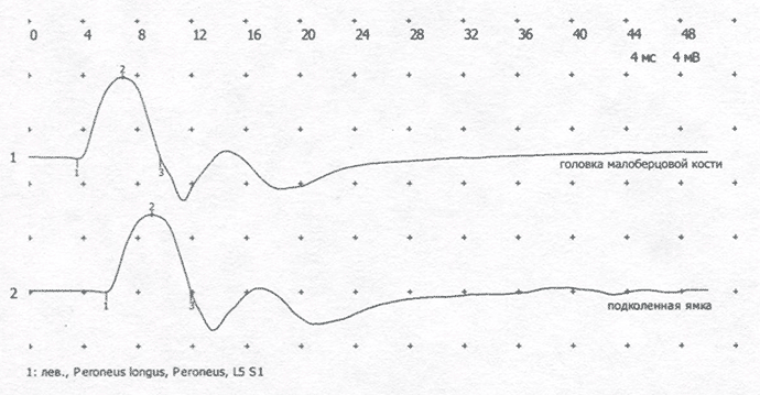 Пример ответов, полученных при исследовании поверхностного малоберцового нерва