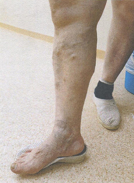 Венозный отёк Венозный отёк