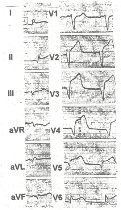 страя стадия инфаркта миокарда с зубцом Q передне-перегородочной, боковой и нижней локализации