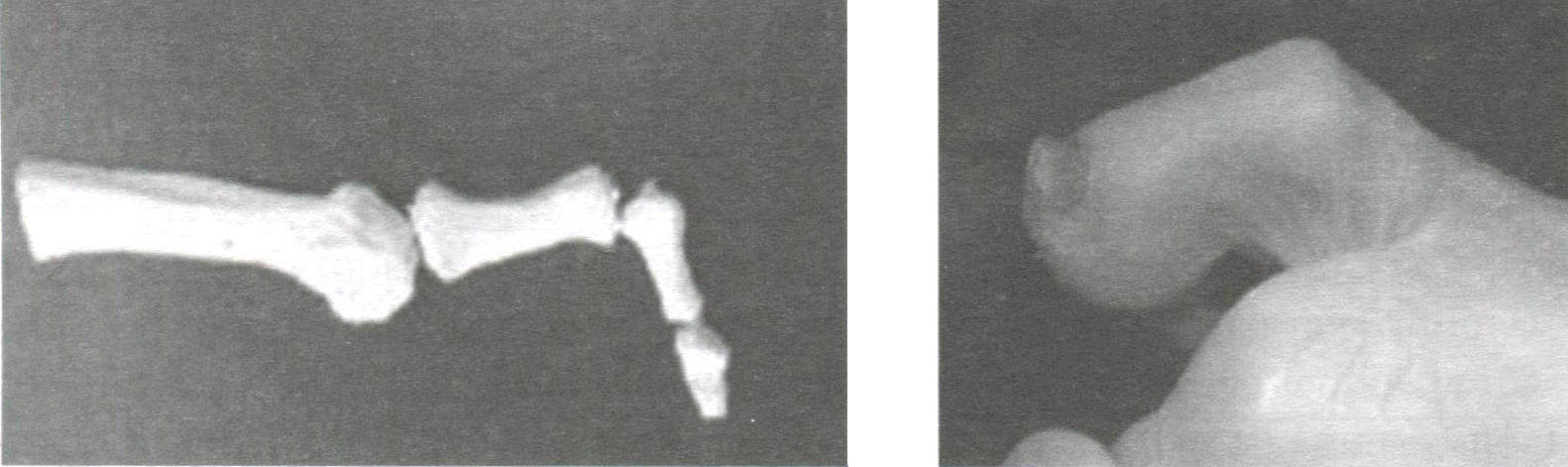  Сгибательная молоткообразная деформация пальца - hammer toe (PIP flexion)