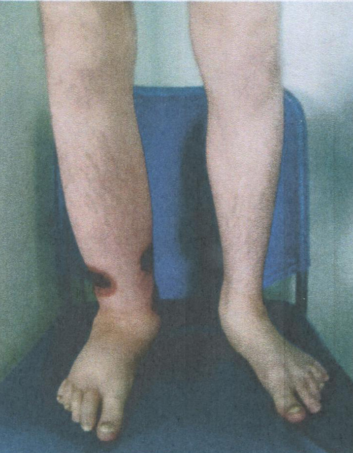 Лимфатический отёк правой нижней конечности, развившийся на фоне рожи Лимфатический отёк правой нижней конечности, развившийся на фоне рожи