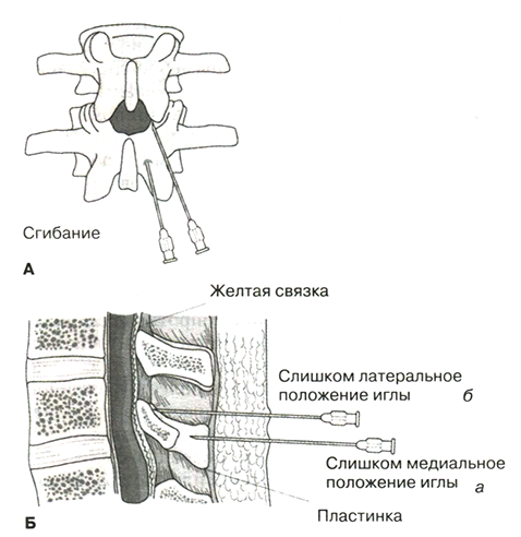  Околосрединный доступ. Если игла упирается в кость неглубоко от кожи