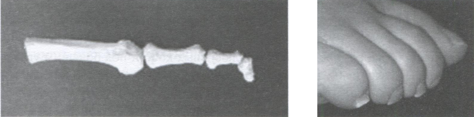 Сгибательная молоткообразная деформация пальца - mallet toe [DIP flexion)