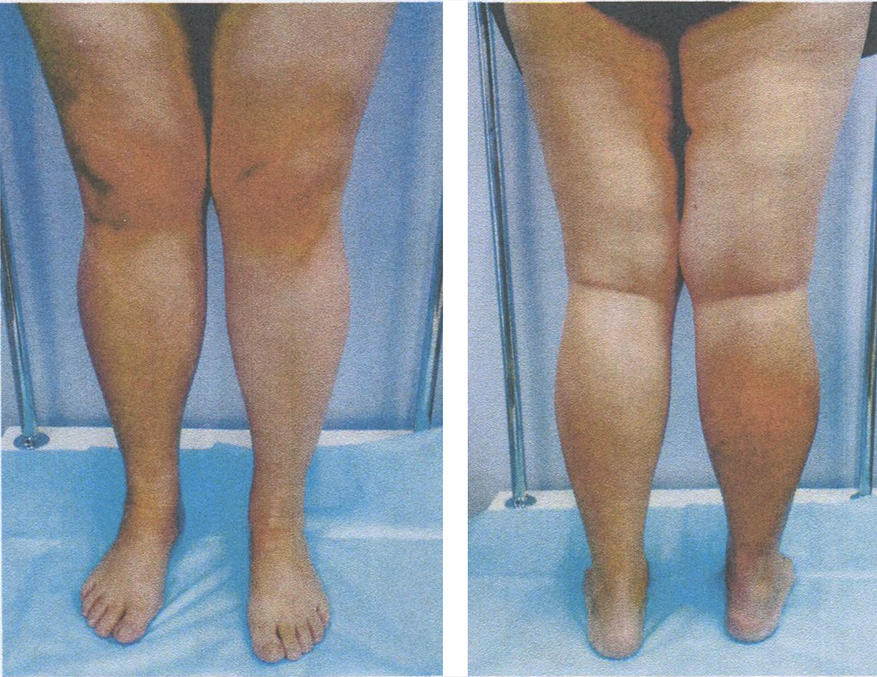 Односторонний отёк у пациентки с посттромботической болезнью правой нижней конечности Односторонний отёк у пациентки с посттромботической болезнью правой нижней конечности