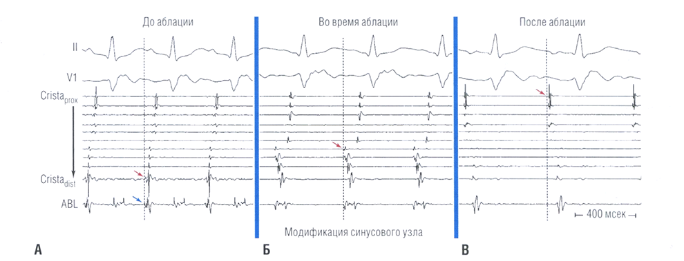 Интракардиальные записи во время модификации синусового узла