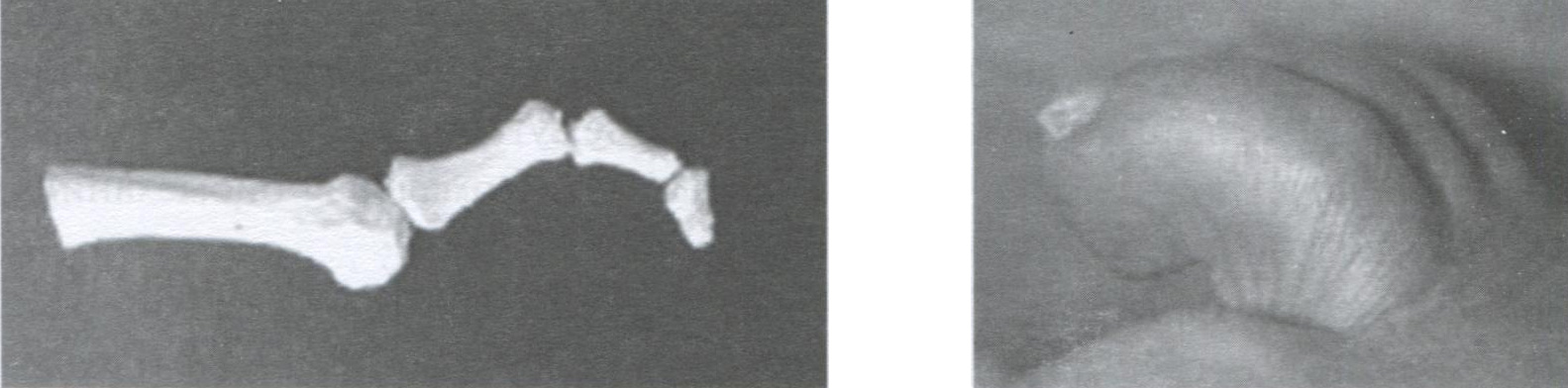  Сгибательно-разгибательная молоточкообразная деформация пальца - claw toe