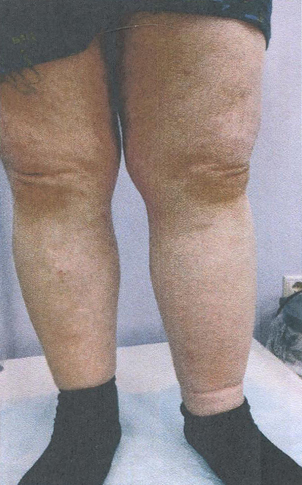 Сердечные отёки обеих нижних конечностей Сердечные отёки обеих нижних конечностей