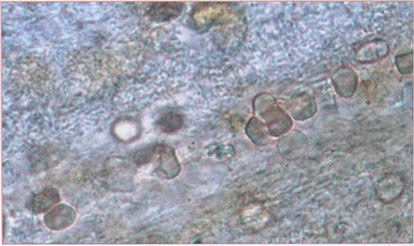 Эритроциты в кале на фоне слизи. Нативный препарат. Иммерсия, х1000 Эритроциты в кале на фоне слизи. Нативный препарат. Иммерсия, х1000